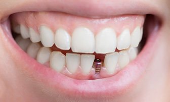 Close-up of mouth with unrestored dental implant